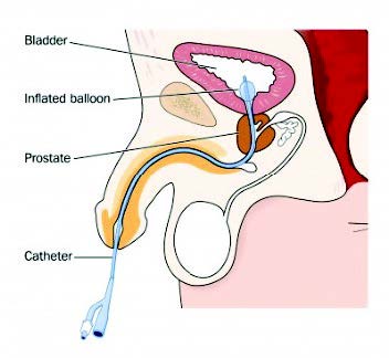  La ilustración muestra cómo se realiza la prueba de urodinámica. Se observa la sonda que se introduce por la uretra a la vejiga, que tiene un globo inflado en el extremo. 