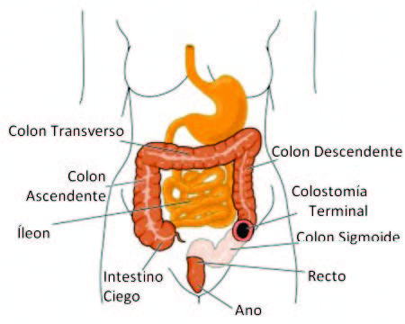 Una imagen de una colostomía enseña el estoma, un agujero en el colon donde que coloca  una bolsa para permitir que pasen la heces fuera del cuerpo sin tener que pasar por el recto.