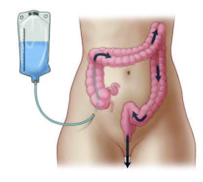 Una imagen enseña la colocación de un catéter tipo enema por el estoma para permitir la irrigación de las heces fuera del colon.