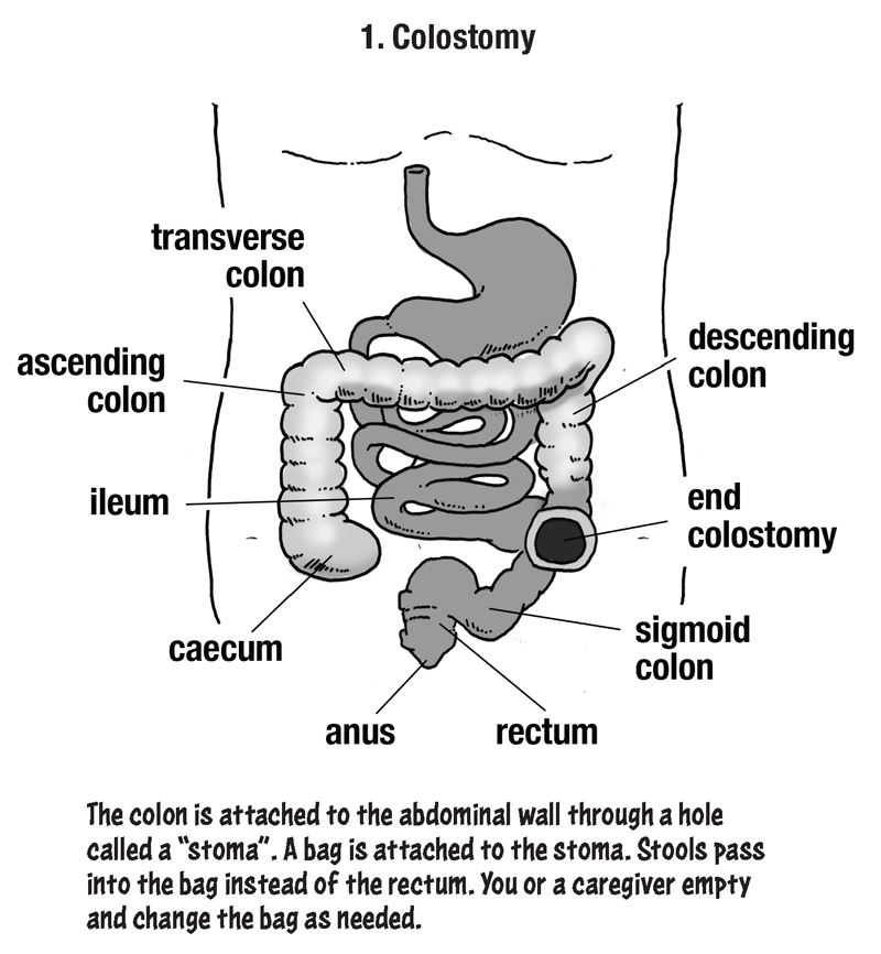 The first surgery option is a colostomy in which the colon is attached to the abdominal wall through a hole called a stoma. A bag is attached to the stoma. Stools pass into the bag instead of the rectum. You or a caregiver empty and change the bag as needed.