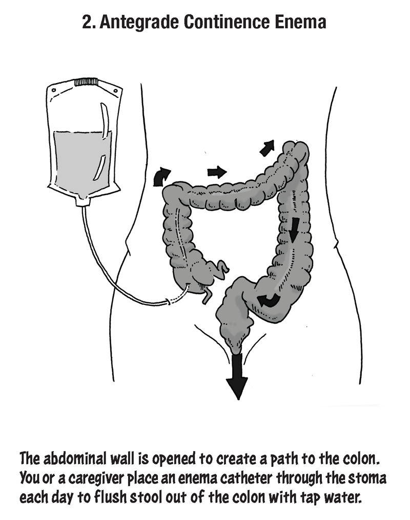 The second surgery option is antegrade continence enema in which the abdominal wall is opened to create a path to the colon. You or a caregiver place an enema catheter through the stoma each day to flush stool out of the colon with tap water.