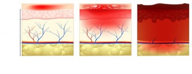 Wound Type