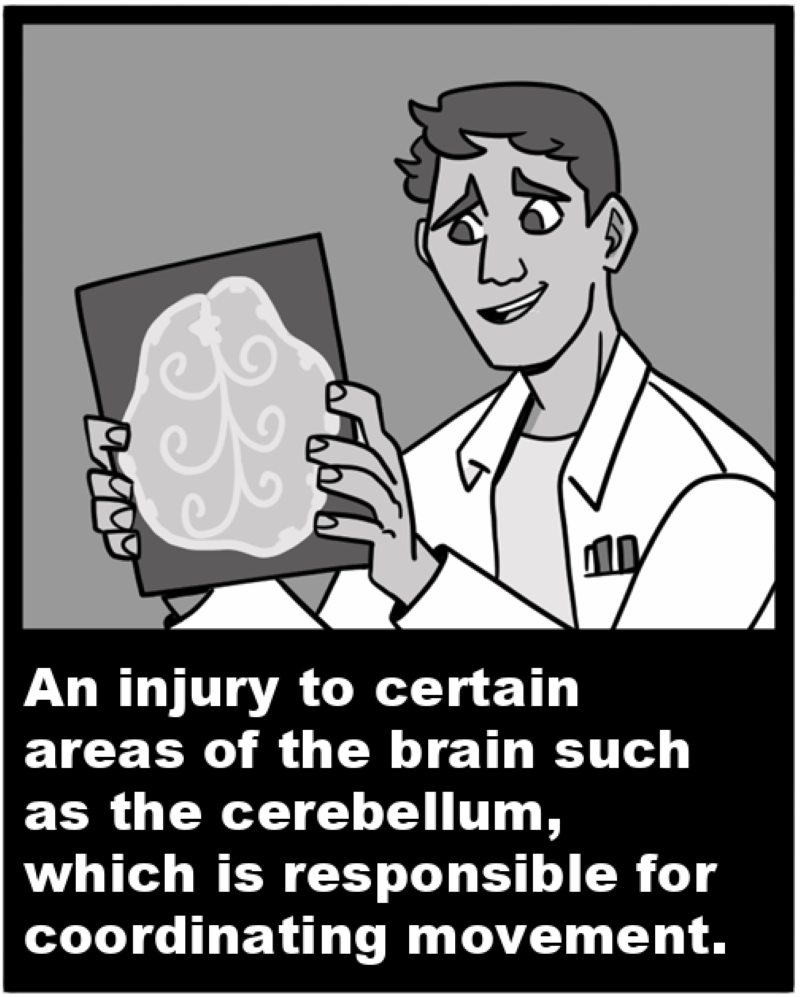 An injury to certain areas of the brain such as the cerebellum, which is responsible for coordinating movement. 