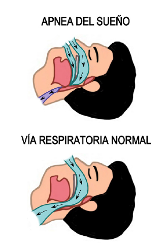 Sleep Apnea
