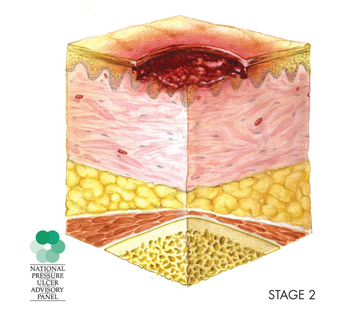 Sección transversal de una úlcera por presión en la etapa 2. La capa exterior más delgada de la piel se ha desgarrado y la llaga está empezando a alcanzar la segunda capa gruesa.