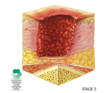 A diagram depicts a stage 3 pressure injury, in which the wound includes the epidermis and dermis and extends into subcutaneous, or fatty, tissue.