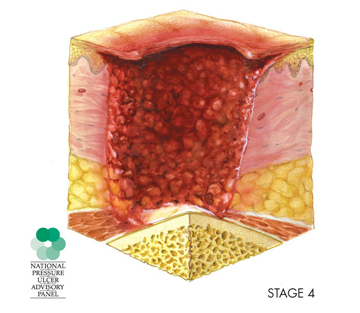 A diagram depicts a stage 4 pressure injury, in which the wound extends through the fatty tissue and into the muscle tissue.