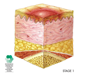 Sección transversal de una úlcera por presión en la etapa 1. La piel no está desgarrada y la llaga no se extiende más allá de la primera capa de piel.