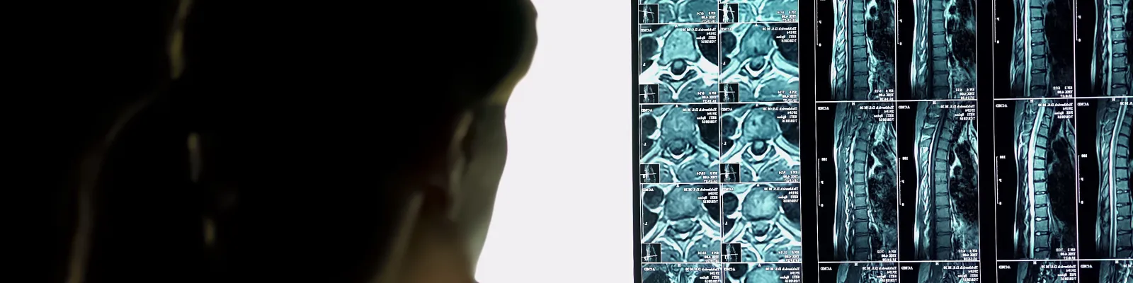 Person looking at an xray of a spine