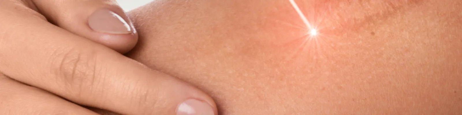 Laser Therapy