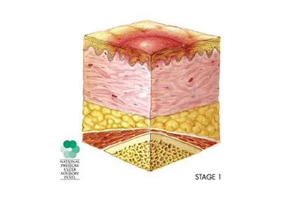 NPUAP stage 1
