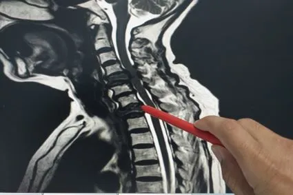 Person pointing to a x-ray of a spine