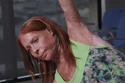 Exercise After Burn Injury
