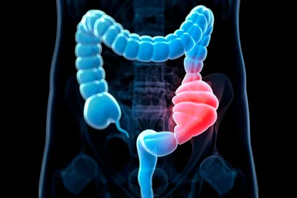 Illustration of obstructed bowel