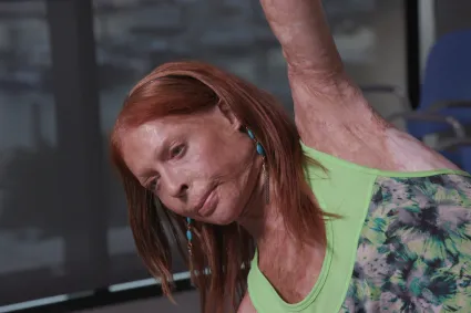 Photo of woman with burn injury doing yoga
