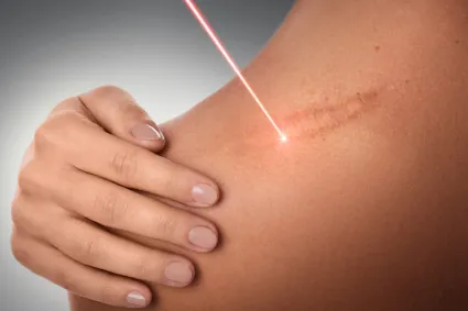 Laser Therapy