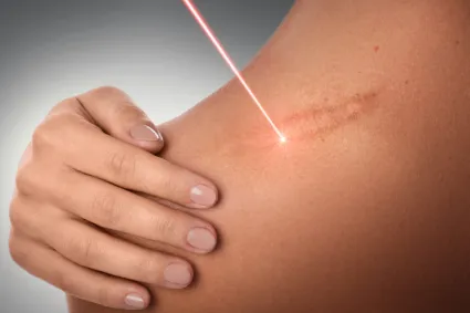Laser Therapy