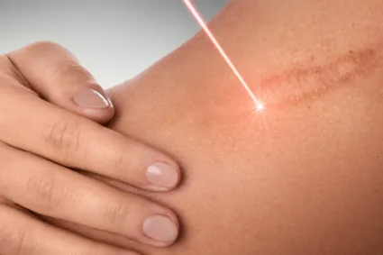 Laser Therapy