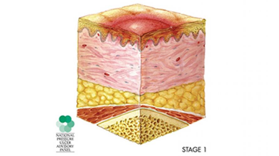 Sección transversal de una úlcera por presión