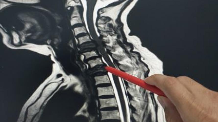 Person pointing to a x-ray of a spine
