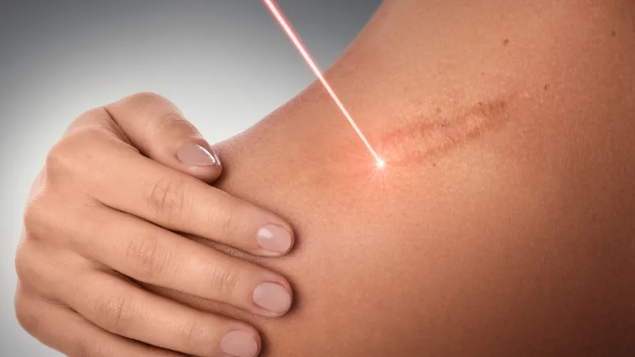 Laser Therapy